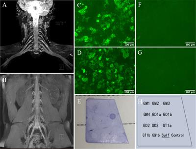 Case report: Autoimmune nodopathy with concurrent serum and CSF IgG4 anti-neurofascin 155 antibodies